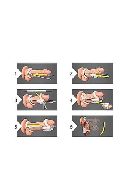 Ekspander powiększanie penisa efekt - 8